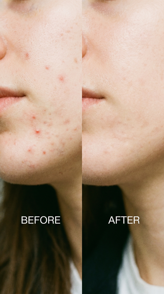 Understanding Post-Acne Marks (And Why They Take Time)